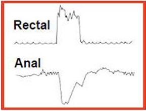 Anal Manometri Dissinerji Normal