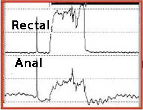 Anal Manometri Tip I Dissinerji, basurum