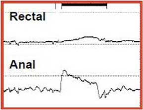 Anal Manometri Tip II Dissinerji, basurum