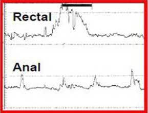 Anal Manometri Tip III Dissinerji, basurum