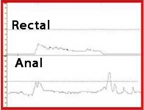 Anal Manometri Tip IV Dissinerji, basurum