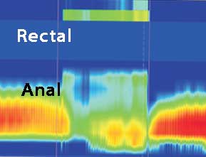 Anal Manometri Dissinerji basurum