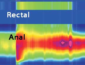 Anal Manometri Tip I Dissinerji basurum