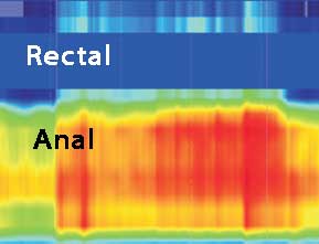 Anal Manometri Tip II Dissinerji basurum