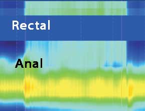 Anal Manometri Tip III Dissinerji basurum