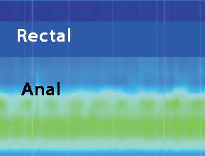 Anal Manometri Tip IV Dissinerji basurum