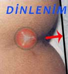 Perineal Descent basurum