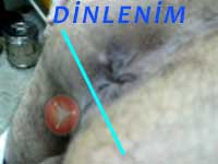 Pelvik Taban düşüklüğü basurum