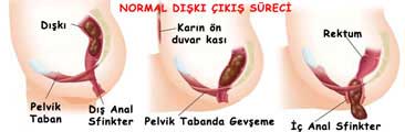Normal Dışkılama basurum