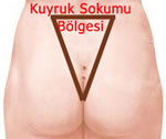 pilonidal sinus, kıl dönmesi pilonidal sinus, kıl dönmesi basurum