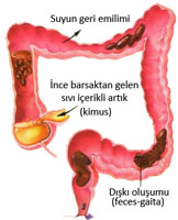 Normal Dışkı Oluşumu basurum Normal Dışkı Oluşumu basurum