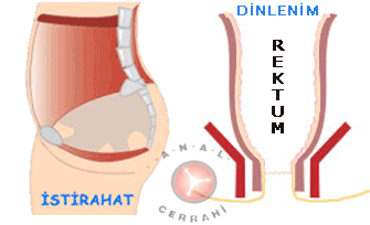 Rektal İntussussepsiyon Intussusception basurum