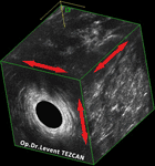 Endoanal Ultrason apse basurum
