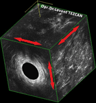 Endoanal Ultrason Apse basurum