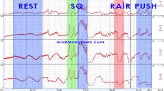 Klasik Anal Manometri basurum