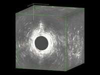 Endoanal Ultrason gif basurum