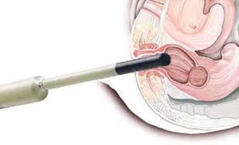 Endoanal Ultrason prob basurum