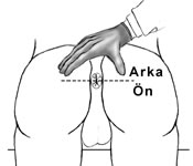 Anal Fistül Goodsall's Anal Fistül Goodsall's basurum