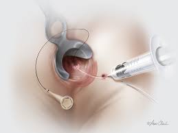 Anal Fistül Plug/tıkaç basurum