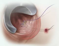 Anal Fistül Plug/Tıkaç basurum