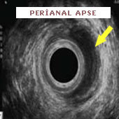 Endoanal Ultrason perianal apse basurum