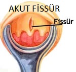 Akut Anal Fissür Akut Anal Fissür basurum