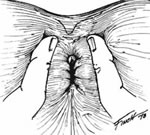 Anal Muayene basurum