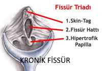 Kronik Anal Fissür Triadı Kronik Anal Fissür triadı basurum