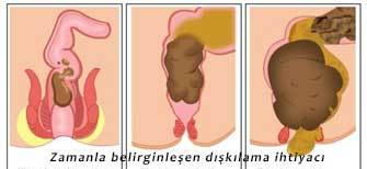 Dışkılama ihtiyacı sıkışma hissi basurum