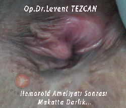 Makat Darlığı, Anal Stenoz Makat Darlığı, Anal Stenoz